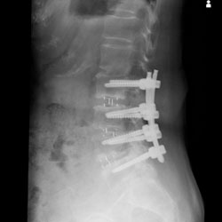 脊柱変形に対する矯正固定術