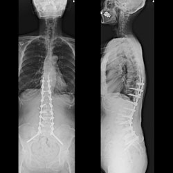 脊柱変形に対する矯正固定術