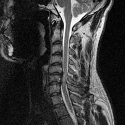 骨を開き、人工骨で固定する方法