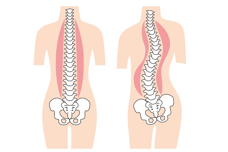 脊柱変形とは