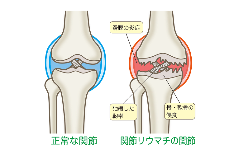 関節リウマチの特徴