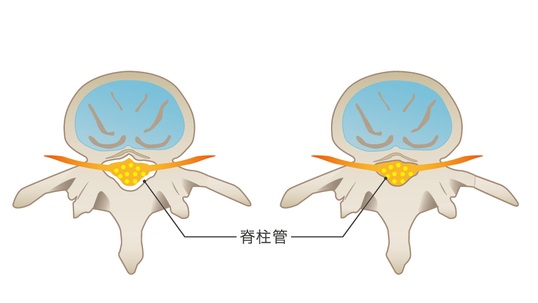 脊柱管狭窄症の原因