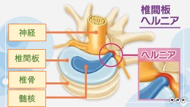 椎間板ヘルニアとは