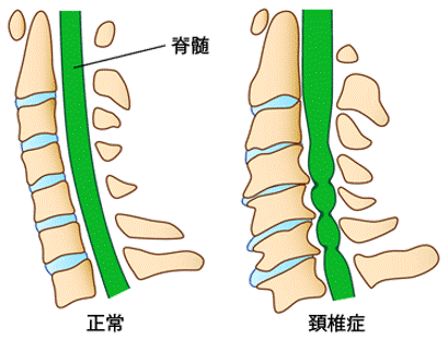 頚椎症