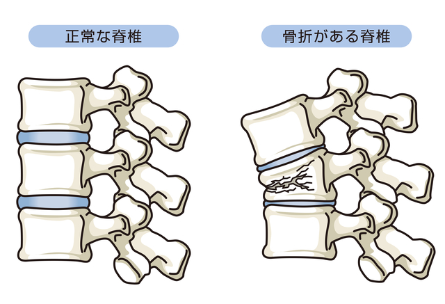 骨粗しょう症圧迫骨折