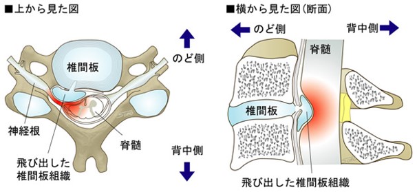 頚椎椎間板ヘルニアとは