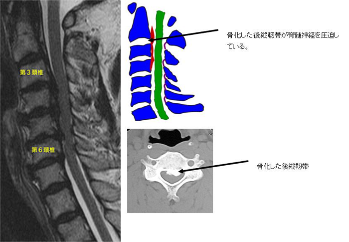 頚椎後縦靭帯骨化症とは