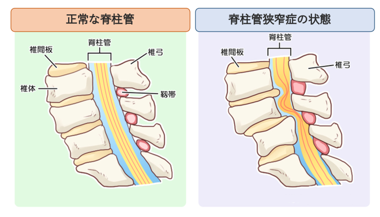 脊柱管狭窄症とはわかりやすく