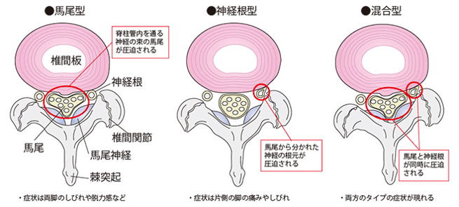 脊柱管狭窄症の症状