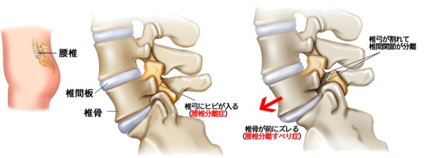 腰椎分離症